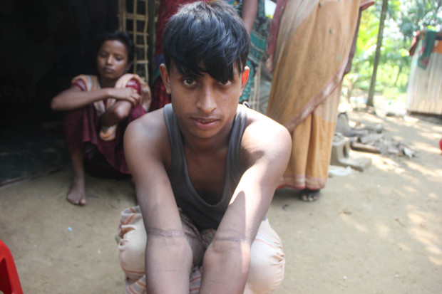 Tajol Shill, a Rohingya Hindu, shows bruises he alleges resulted from torture by Rohingya Muslims who abducted him, Ukhia, Cox's Bazar, Oct. 27, 2017. (Rohit Wadhwaney/BenarNews)