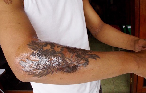 TATTO-REMOVAL-03.jpeg