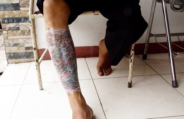 TATTO-REMOVAL-04.jpeg